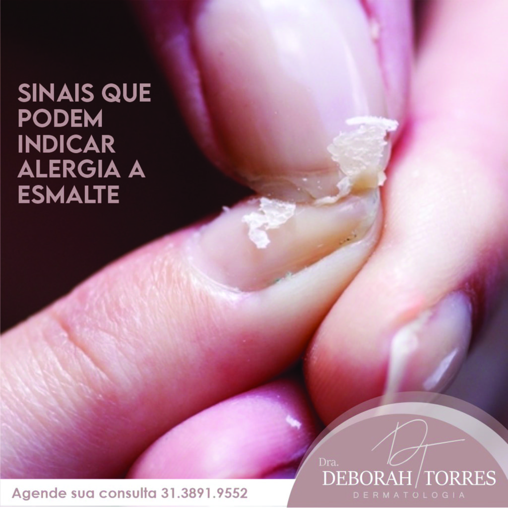 Sinais que podem indicar alergia a esmalte - Líder Notícias | A ...